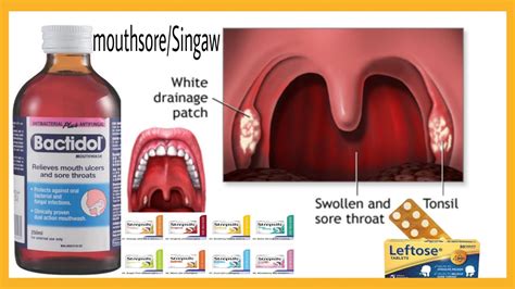 ano ang gamot sa tonsil|Sakit sa Lalamunan: Mga Uri, Sanhi, Sintomas, at Gamot .